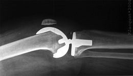 knee replacement x-ray - Wikipedia